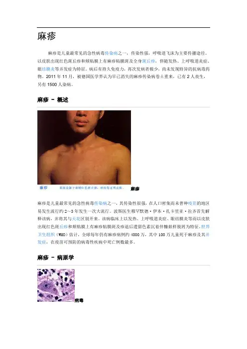 麻疹