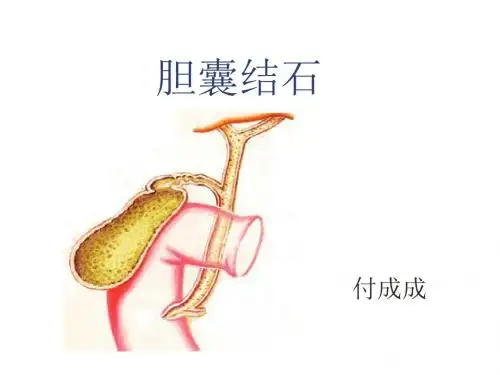胆囊结石及其防治