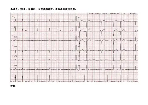 心电图诊断及解析13
