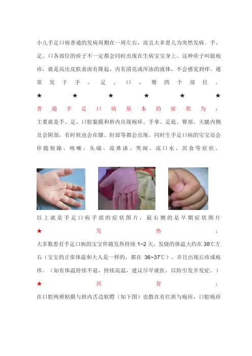 小儿手足口病症状及症状图片