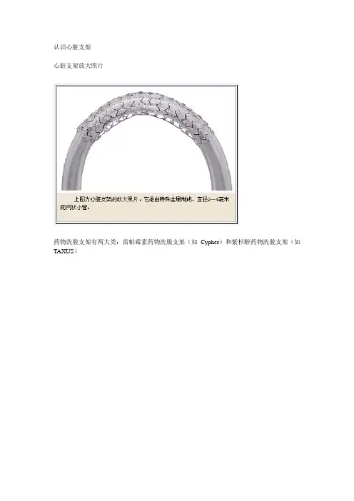 认识心脏支架(附:心脏支架放大照片)