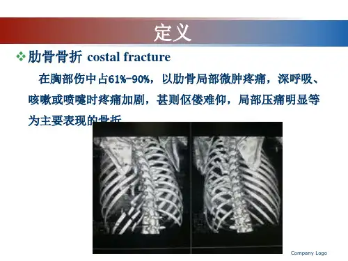 肋骨骨折影像学表现