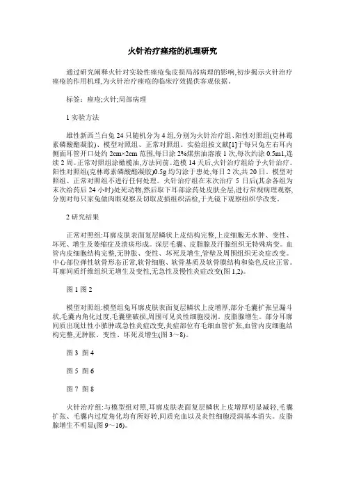火针治疗痤疮的机理研究