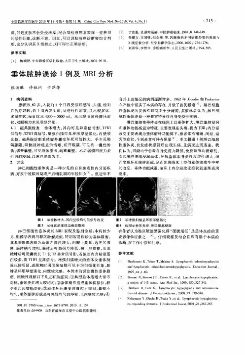 垂体脓肿误诊1例及MRI分析