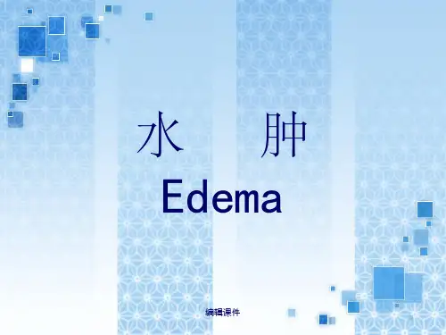 医院诊断学:水肿