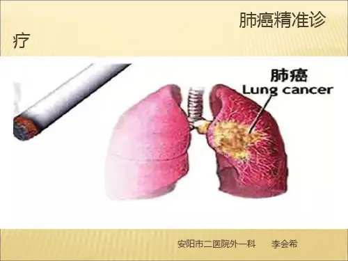 肺癌精准诊疗ppt课件