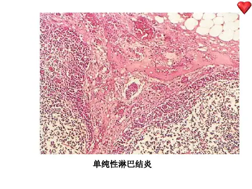 单纯性淋巴结炎