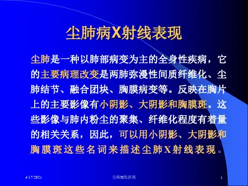 尘肺X线表现课件