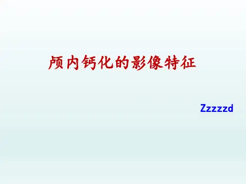 颅内钙化的影像学特征
