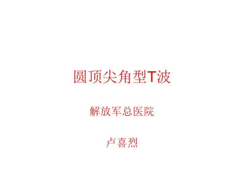 (卢喜烈)圆顶尖角型T波
