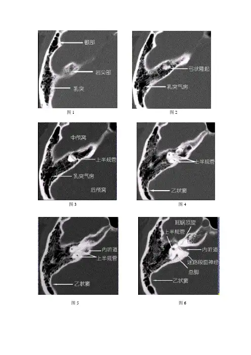 耳部CT及MRI解剖