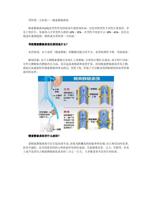 男性第一大疾病——精索静脉曲张