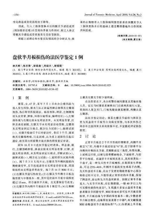 盘状半月板损伤的法医学鉴定1例