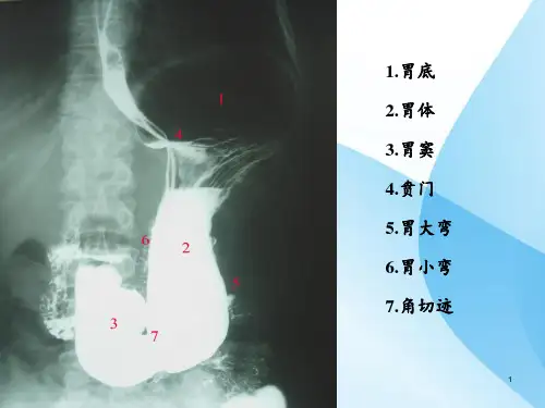 胃疾病影像ppt课件