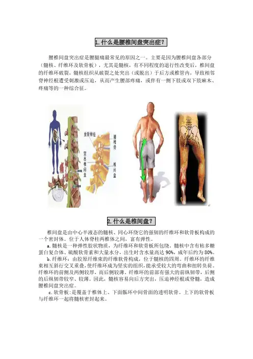 腰椎间盘突出症 2
