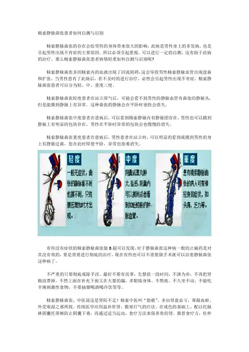 精索静脉曲张患者如何自测与识别