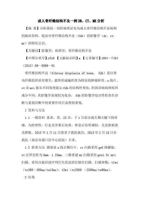 成人骨纤维结构不良一例DR、CT、MR分析