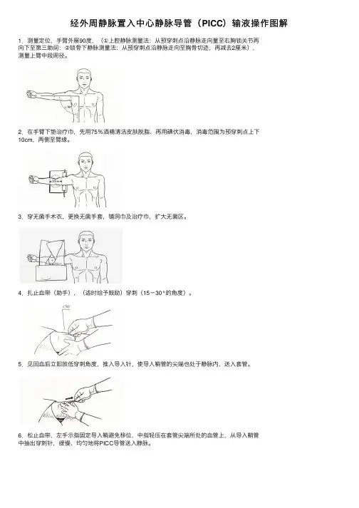 经外周静脉置入中心静脉导管（PICC）输液操作图解