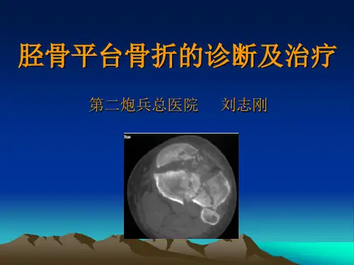 胫骨平台骨折的诊断及治疗