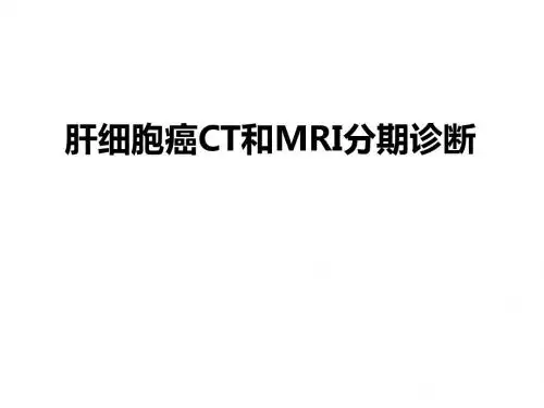 肝癌CT、MRI分期诊断
