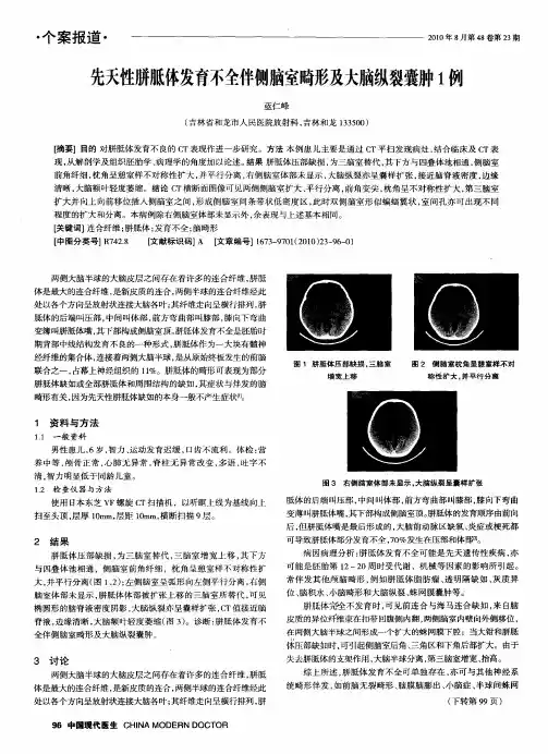 先天性胼胝体发育不全伴侧脑室畸形及大脑纵裂囊肿1例