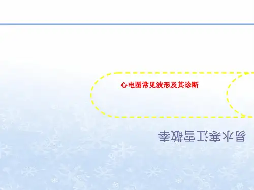 心电图常见波形及其诊断