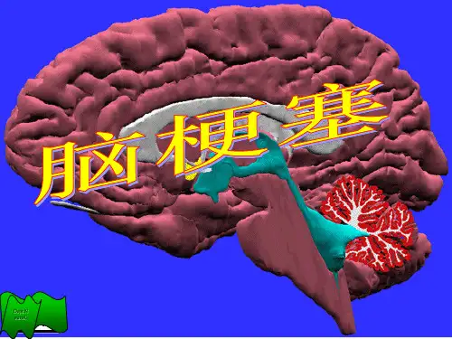 脑梗塞PPT课件