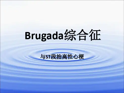 Brugada综合征完整版本