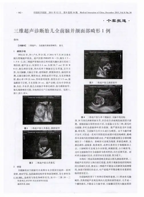 三维超声诊断胎儿全前脑并颜面部畸形1例