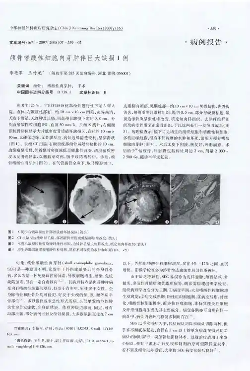 颅骨嗜酸性细胞肉芽肿伴巨大缺损1例