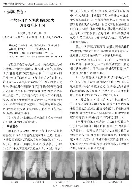 年轻恒牙伴牙根内吸收根尖诱导成形术1例
