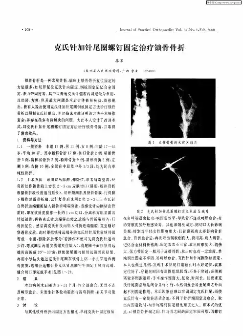 克氏针加针尾圈螺钉固定治疗锁骨骨折