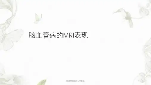 脑血管疾病的MRI表现ppt课件
