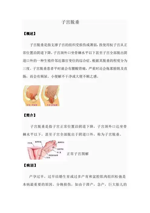 子宫脱垂