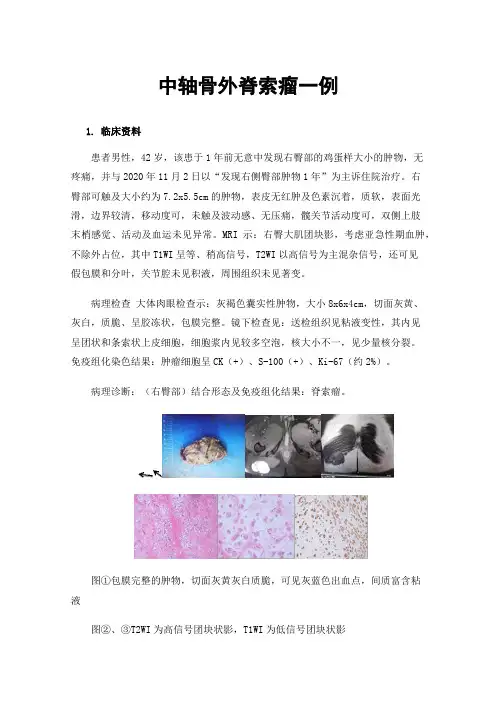 中轴骨外脊索瘤一例