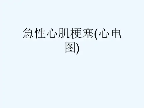 急性心肌梗塞(心电图)[可修改版ppt]