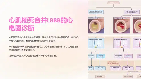 心肌梗死合并LBBB的心电图诊断