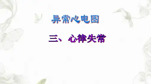 异常心电图图谱汇总ppt课件