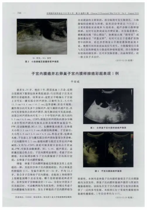 子宫内膜癌并右卵巢子宫内膜样腺癌彩超表现1例