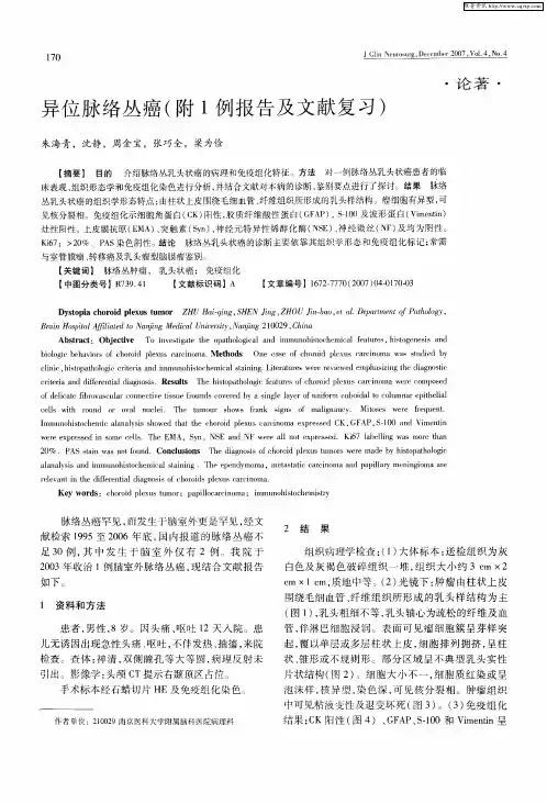 异位脉络丛癌(附1例报告及文献复习)