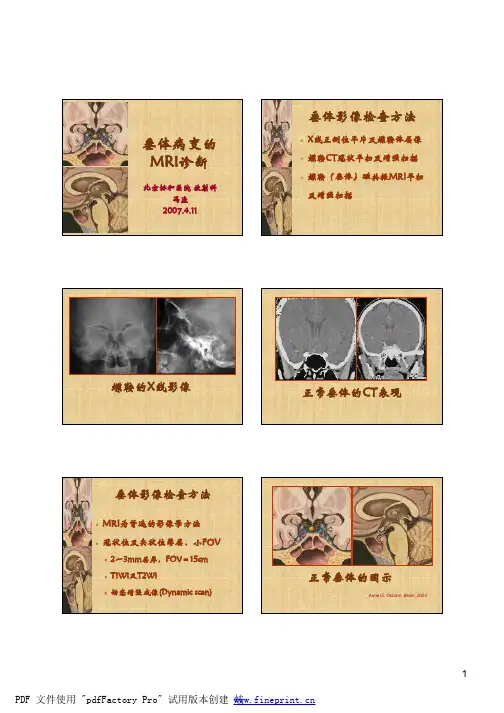 垂体病变的MRI诊断