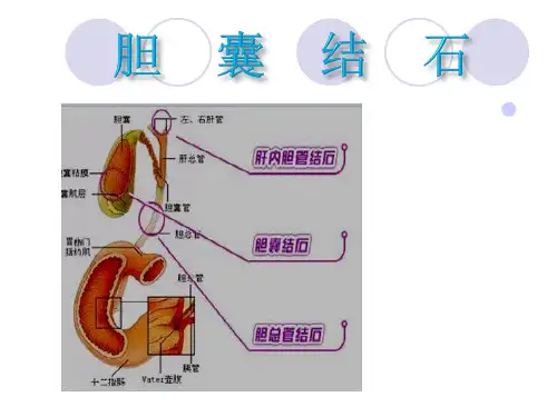 胆囊结石护理 P P Tppt课件