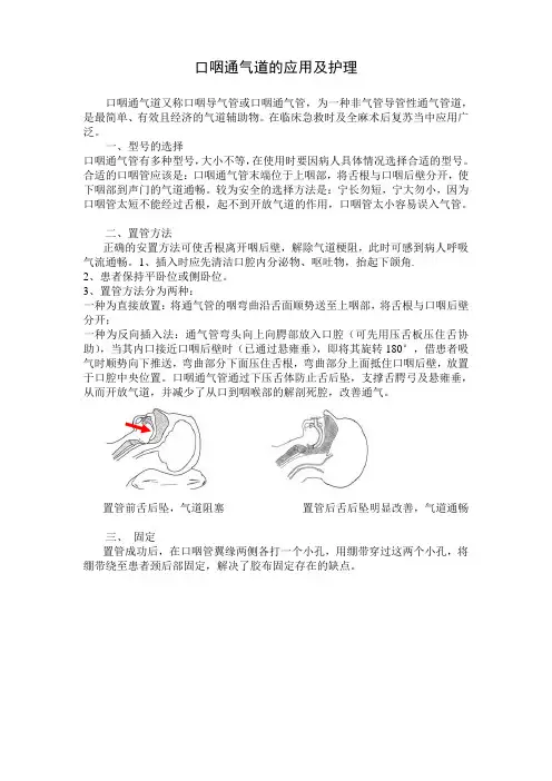 口咽通气道置管操作流程 2