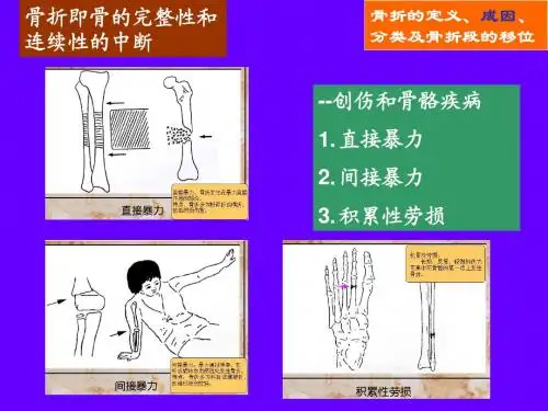 骨折、愈合、康复