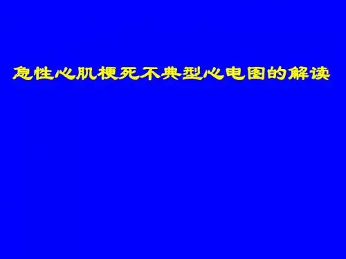 AMI不典型心电图的解读
