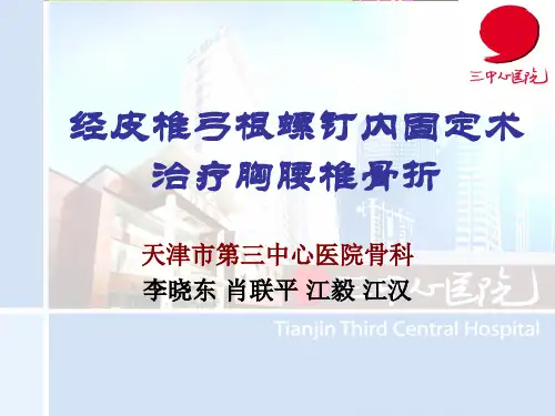 经皮椎弓根螺钉内固定术治疗胸腰椎骨折固定