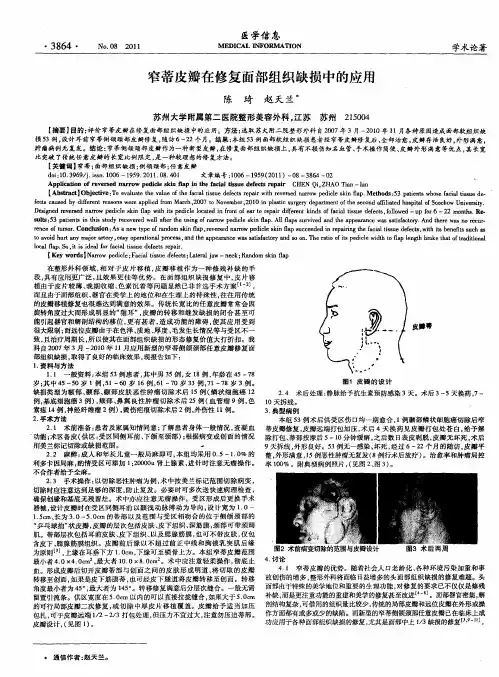窄蒂皮瓣在修复面部组织缺损中的应用