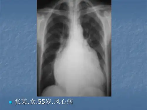 风湿性心脏病的X线表现