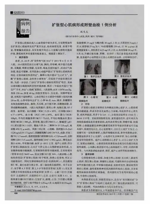 扩张型心肌病形成附壁血栓1例分析