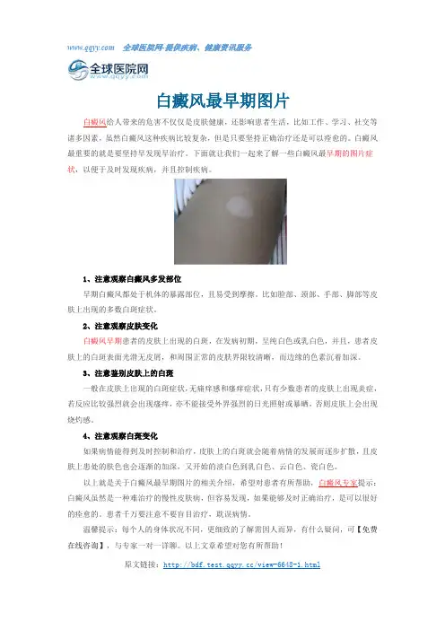 白癜风最早期图片